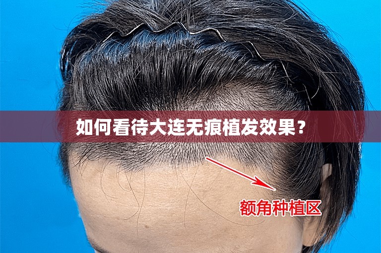 如何看待大连无痕植发效果？