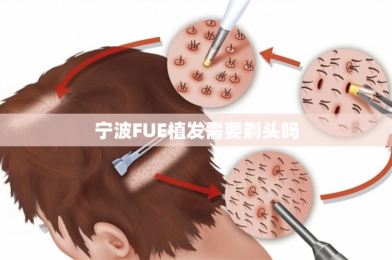 宁波FUE植发需要剃头吗