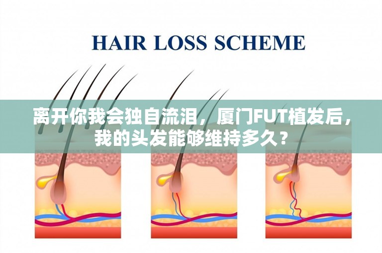 离开你我会独自流泪，厦门FUT植发后，我的头发能够维持多久？