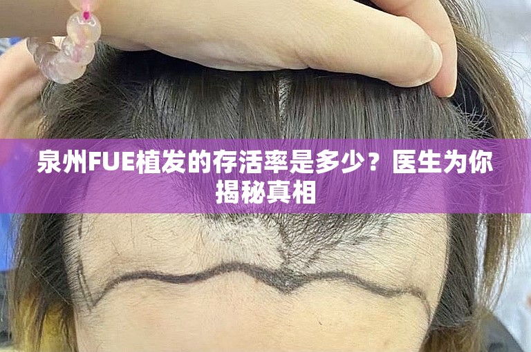 泉州FUE植发的存活率是多少？医生为你揭秘真相