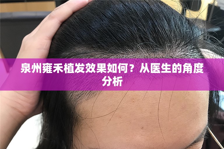 泉州雍禾植发效果如何？从医生的角度分析