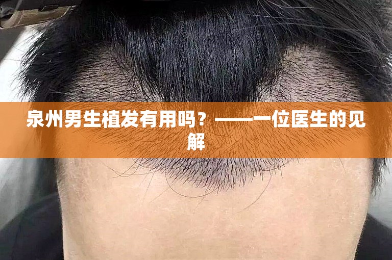 泉州男生植发有用吗？——一位医生的见解