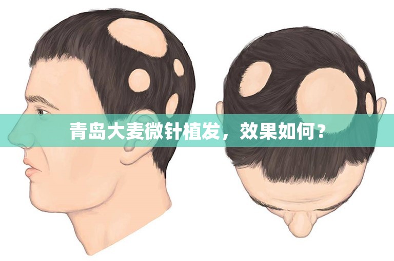 青岛大麦微针植发，效果如何？