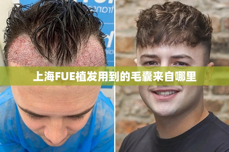 上海FUE植发用到的毛囊来自哪里