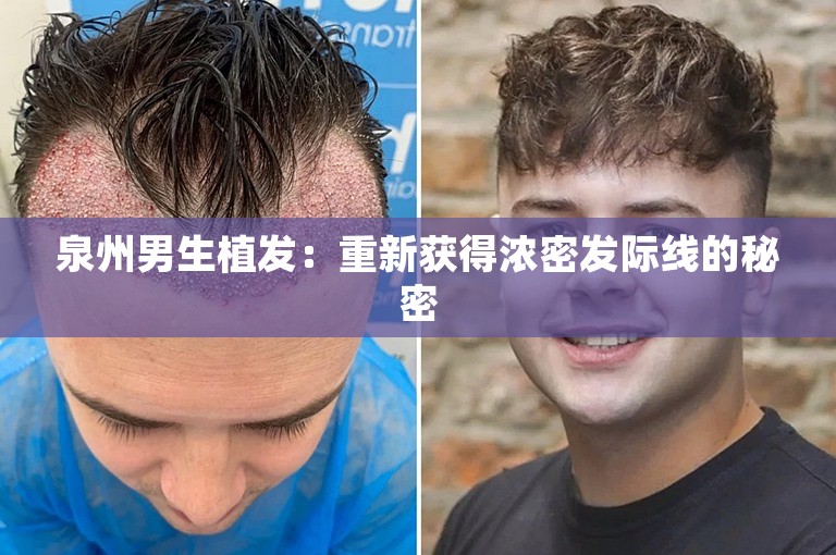 泉州男生植发：重新获得浓密发际线的秘密