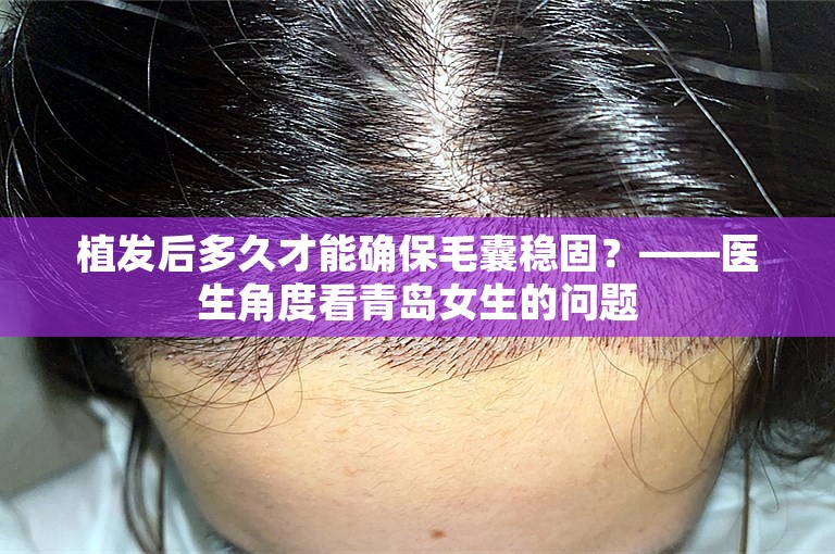 植发后多久才能确保毛囊稳固？——医生角度看青岛女生的问题