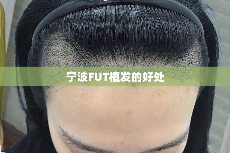 宁波FUT植发的好处