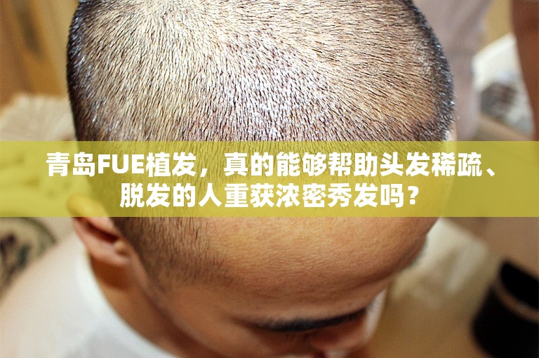 青岛FUE植发，真的能够帮助头发稀疏、脱发的人重获浓密秀发吗？