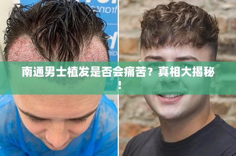 南通男士植发是否会痛苦？真相大揭秘！