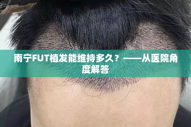 南宁FUT植发能维持多久？——从医院角度解答