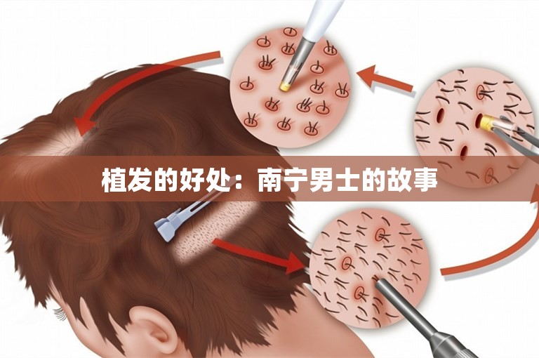 植发的好处：南宁男士的故事