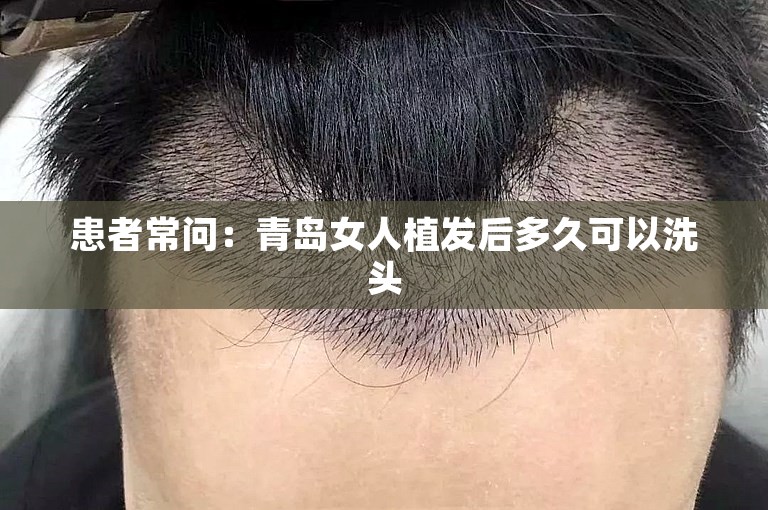 患者常问：青岛女人植发后多久可以洗头