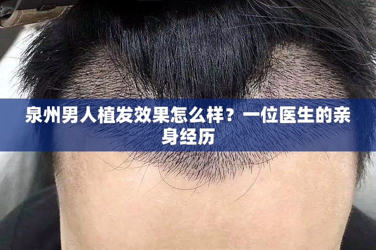 泉州男人植发效果怎么样？一位医生的亲身经历