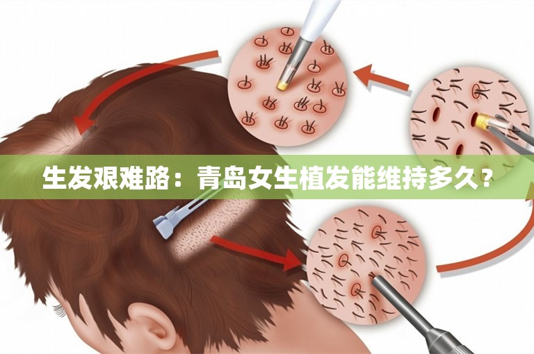 生发艰难路：青岛女生植发能维持多久？