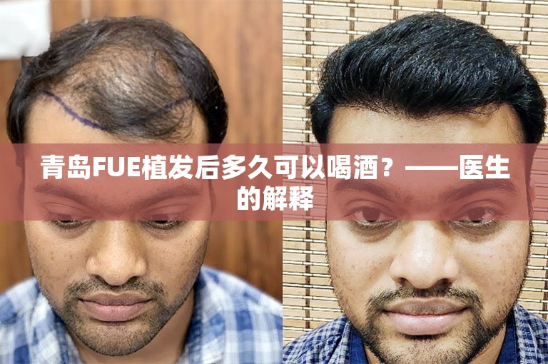 青岛FUE植发后多久可以喝酒？——医生的解释