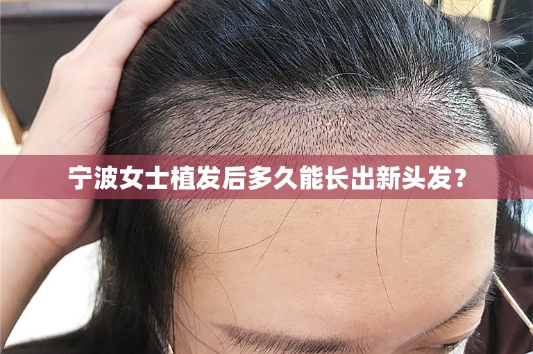 宁波女士植发后多久能长出新头发？