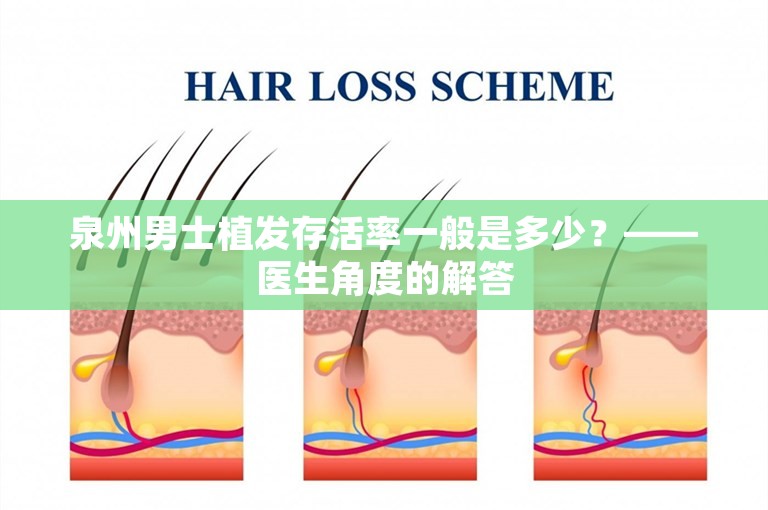 泉州男士植发存活率一般是多少？——医生角度的解答