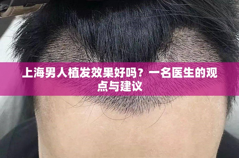 上海男人植发效果好吗？一名医生的观点与建议