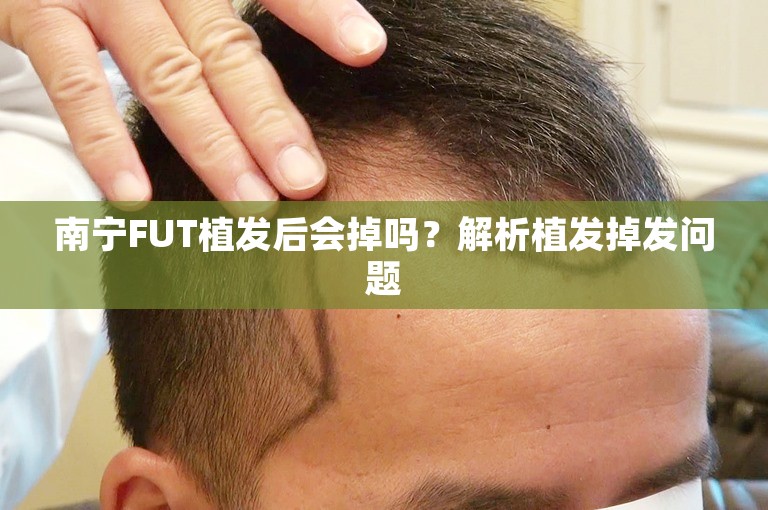 南宁FUT植发后会掉吗？解析植发掉发问题