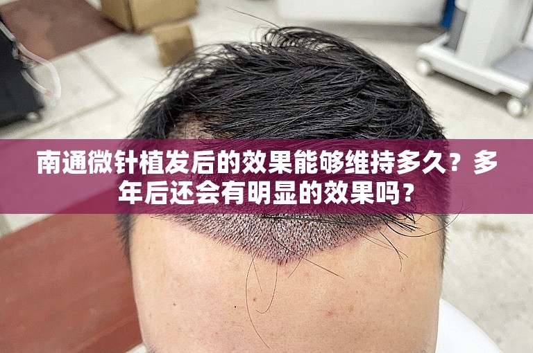 南通微针植发后的效果能够维持多久？多年后还会有明显的效果吗？