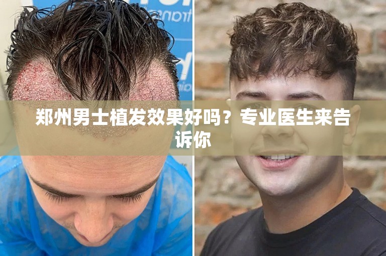 郑州男士植发效果好吗？专业医生来告诉你