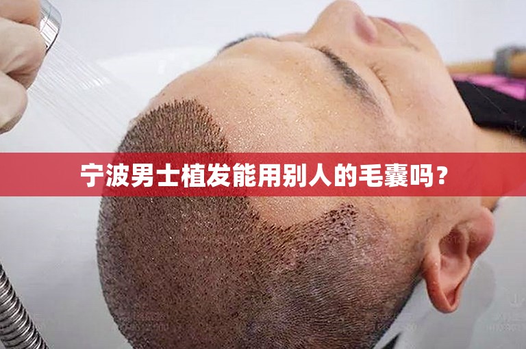 宁波男士植发能用别人的毛囊吗？