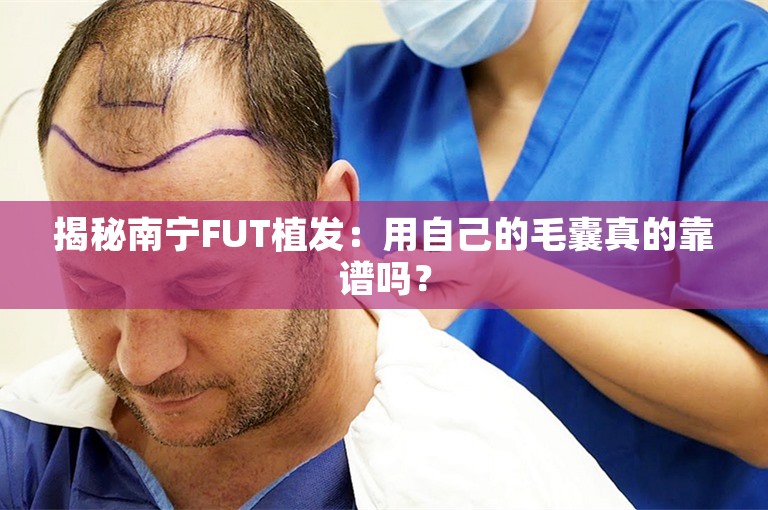 揭秘南宁FUT植发：用自己的毛囊真的靠谱吗？