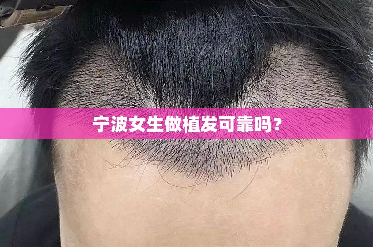 宁波女生做植发可靠吗？