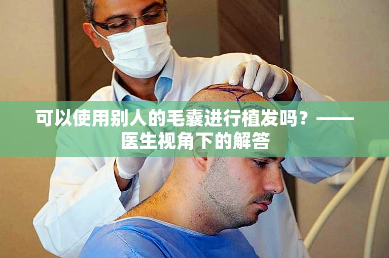 可以使用别人的毛囊进行植发吗？——医生视角下的解答