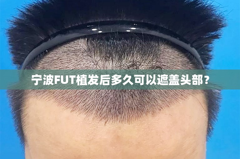 宁波FUT植发后多久可以遮盖头部？