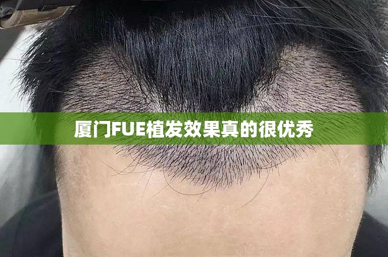 厦门FUE植发效果真的很优秀