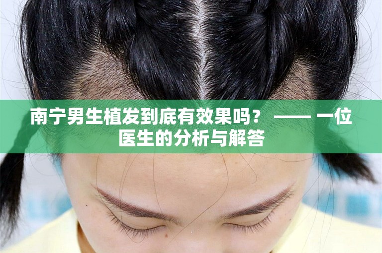 南宁男生植发到底有效果吗？ —— 一位医生的分析与解答