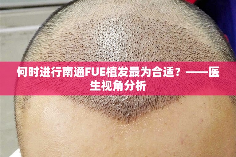 何时进行南通FUE植发最为合适？——医生视角分析