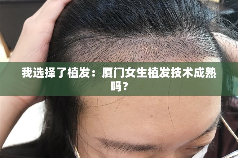 我选择了植发：厦门女生植发技术成熟吗？