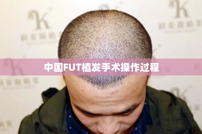 中国FUT植发手术操作过程