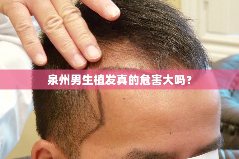 泉州男生植发真的危害大吗？