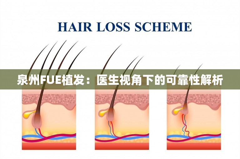 泉州FUE植发：医生视角下的可靠性解析