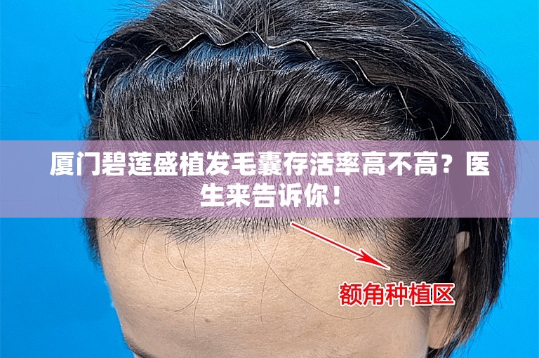 厦门碧莲盛植发毛囊存活率高不高？医生来告诉你！