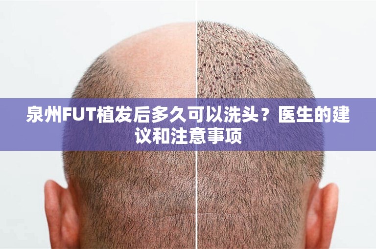 泉州FUT植发后多久可以洗头？医生的建议和注意事项