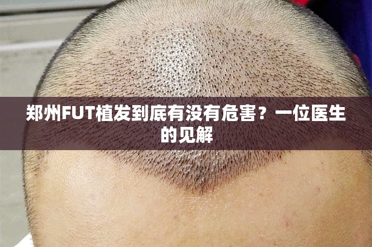 郑州FUT植发到底有没有危害？一位医生的见解