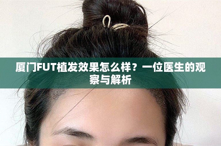 厦门FUT植发效果怎么样？一位医生的观察与解析