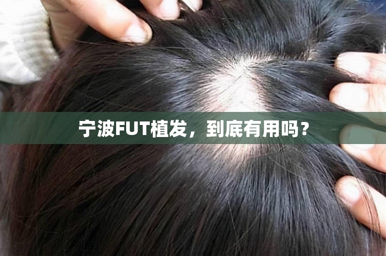 宁波FUT植发，到底有用吗？