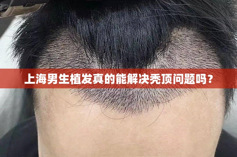 上海男生植发真的能解决秃顶问题吗？