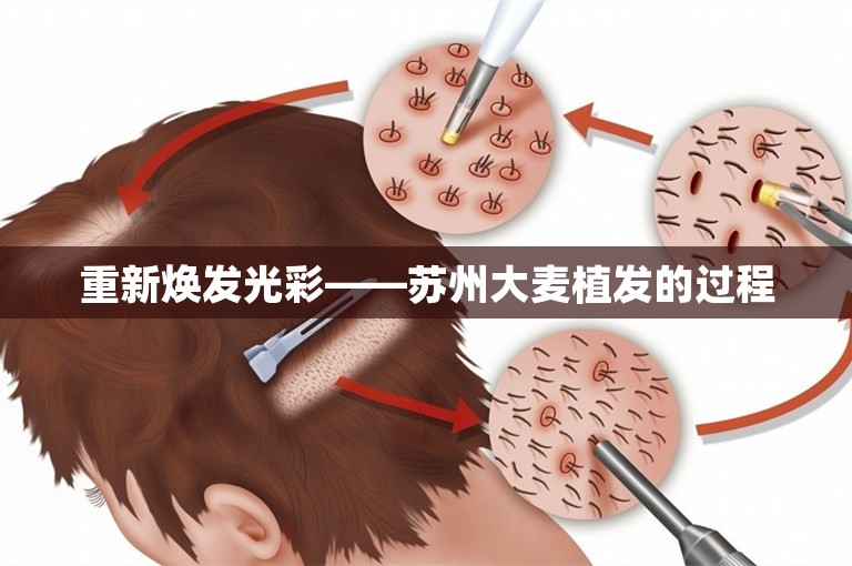 重新焕发光彩——苏州大麦植发的过程