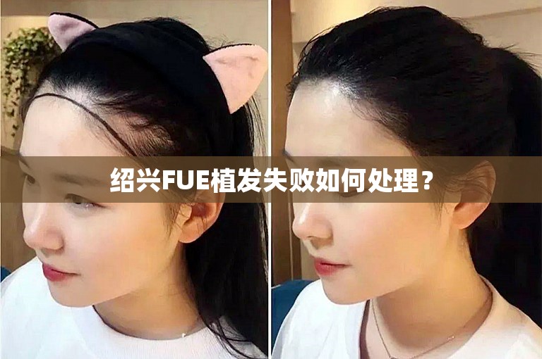 绍兴FUE植发失败如何处理？