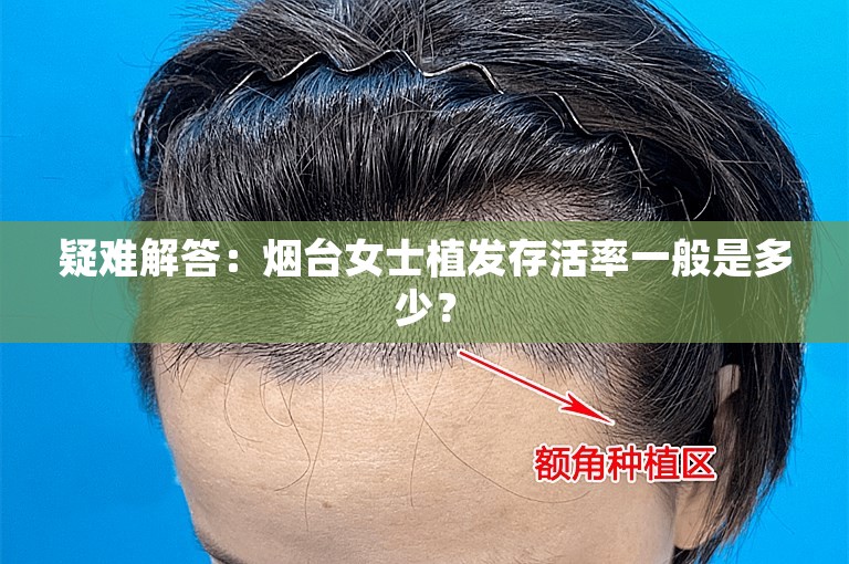 疑难解答：烟台女士植发存活率一般是多少？