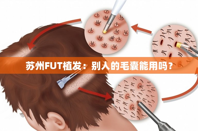 苏州FUT植发：别人的毛囊能用吗？