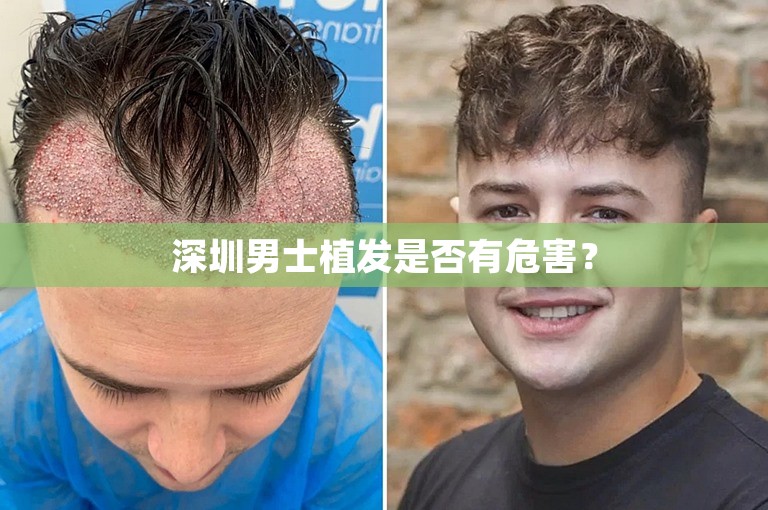 深圳男士植发是否有危害？