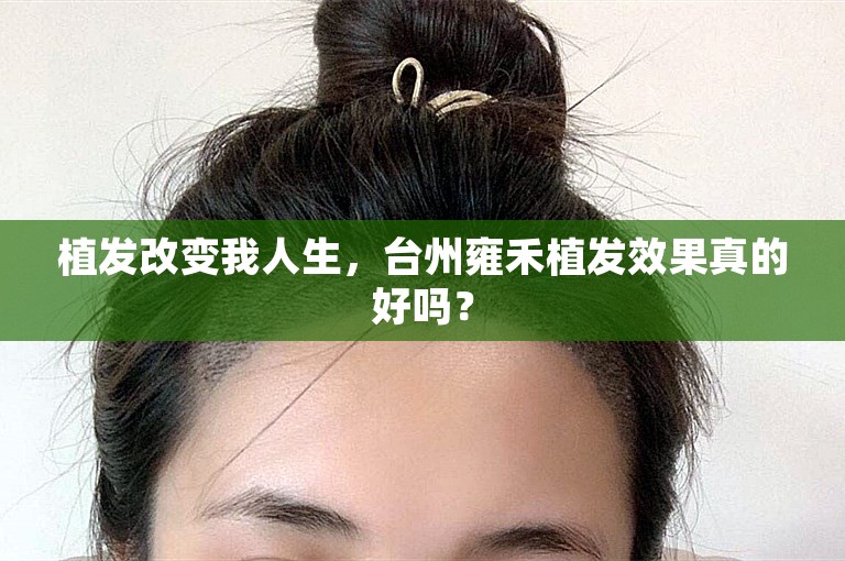 植发改变我人生，台州雍禾植发效果真的好吗？