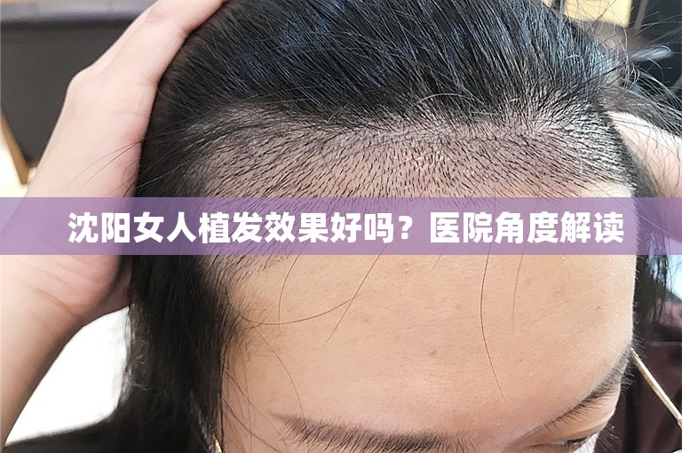  沈阳女人植发效果好吗？医院角度解读